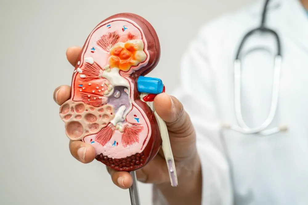 Casos de câncer de rim podem crescer quase 80% no Brasil até 2050 